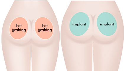 Buttock-augmentation-lipofilling-Drawbacks